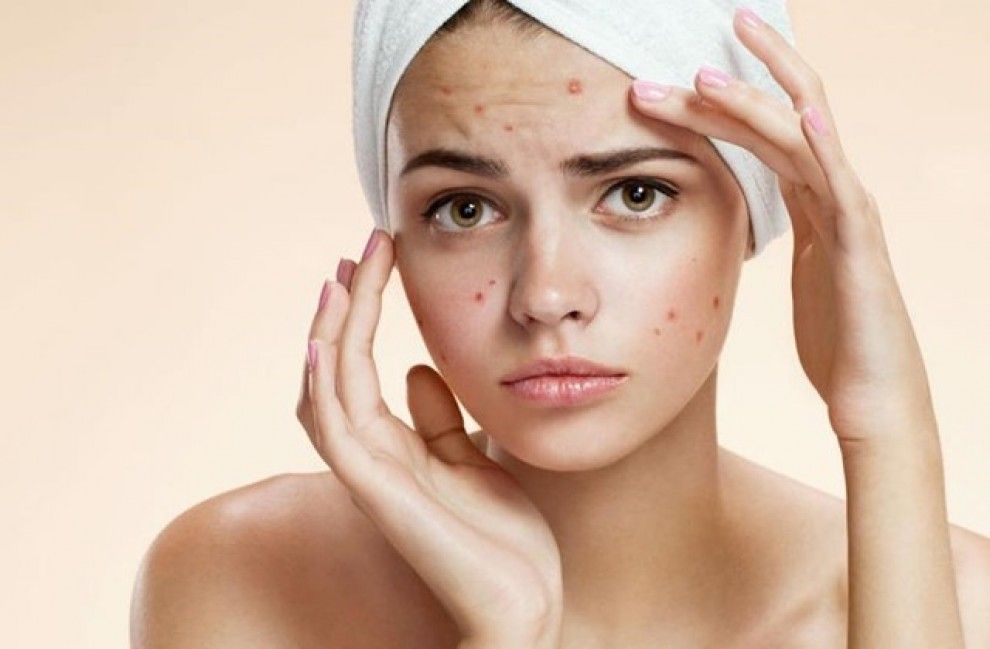L'acne es pot reduir amb una bona alimentació