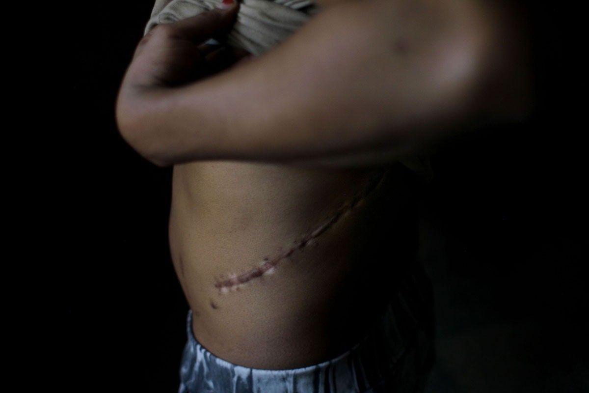 La cicatriu que deixa una extracció il·legal de ronyó a Egipte