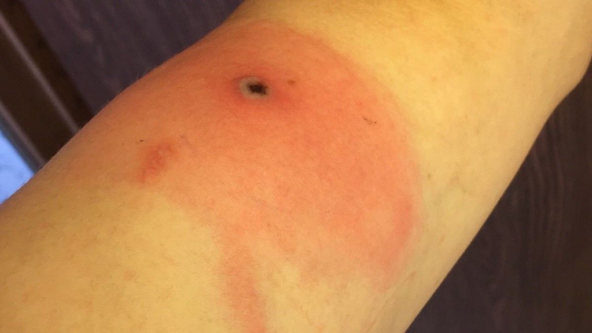Una lesió cutània causada pel virus «Alaskapox»