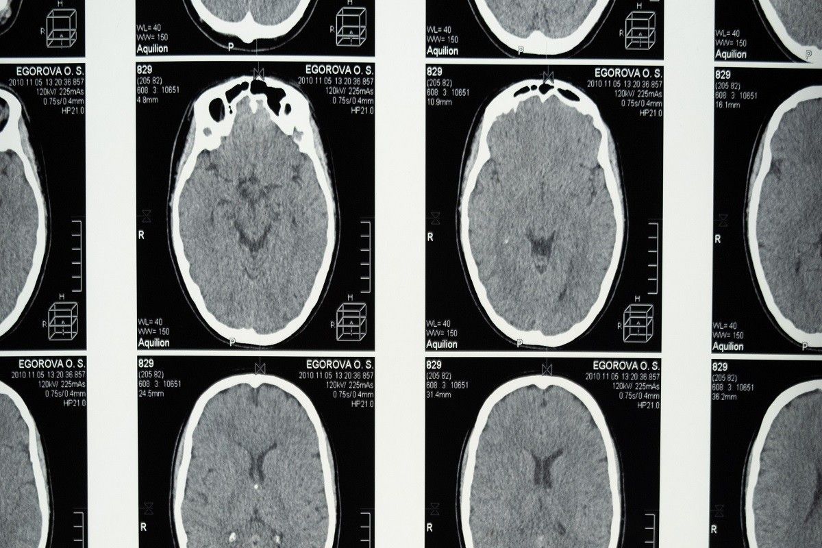 Radiografies del cervell